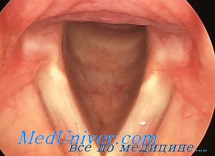 парез гортани