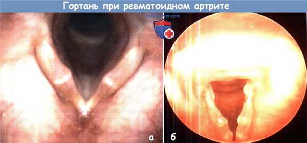 Гортань при ревматоидном артрите