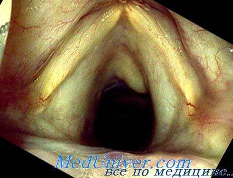 ревматизм гортани