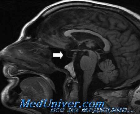 нарушение менструального цикла
