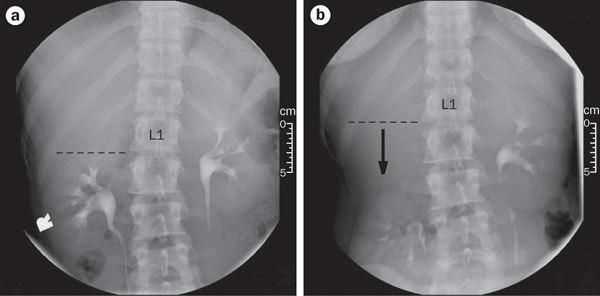 Экскреторная контрастная урография