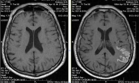 МРТ в диагностике нарушений мозгового кровообращения