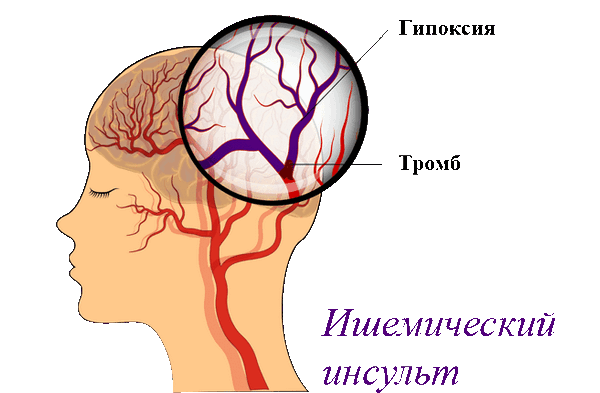 ишемический инсульт