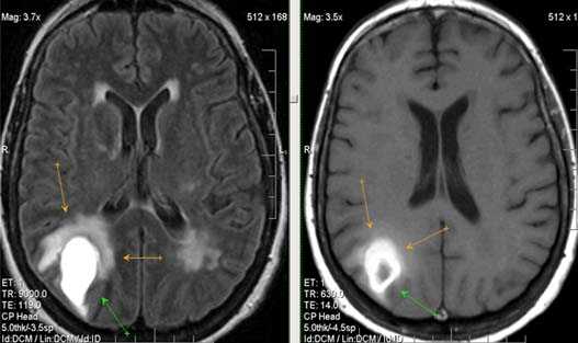 МРТ в диагностике нарушений мозгового кровообращения
