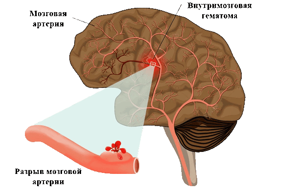 церебральный инсульт