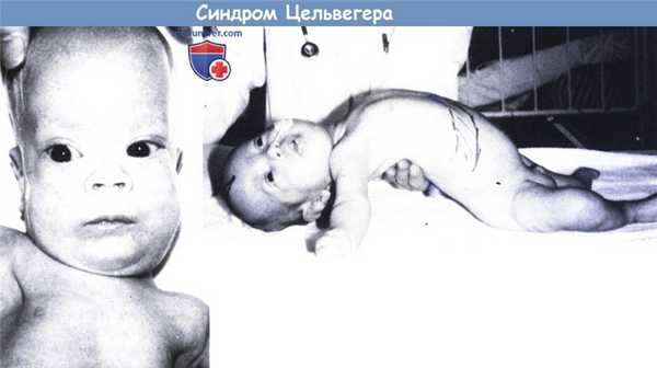 Синдром Цельвегера