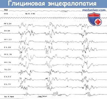 Глициновая энцефалопатия