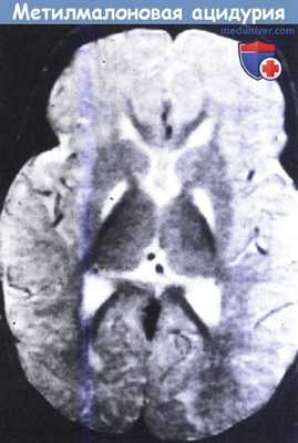МРТ при метилмалоновой ацидурии