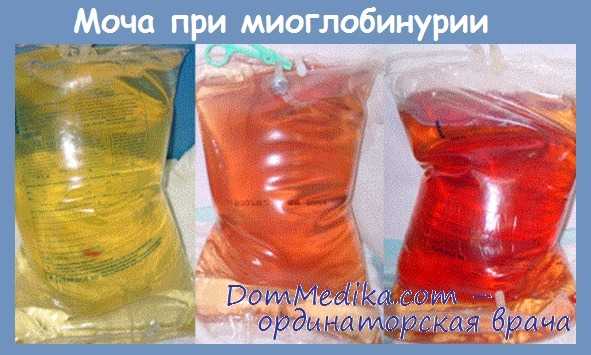 Моча при миоглобинурии