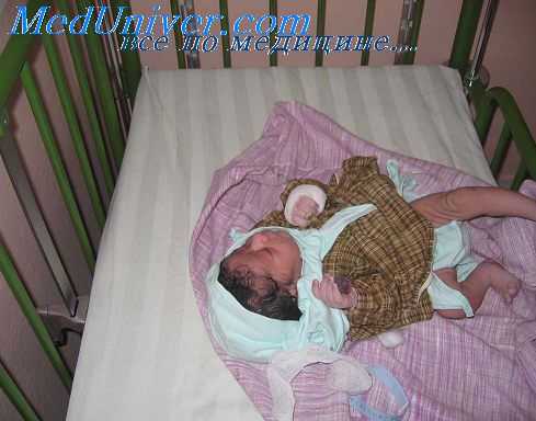 нерегулярный ритм сердца