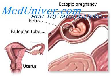 внематочная беременность