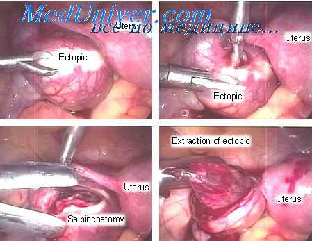 токсикоз беременных