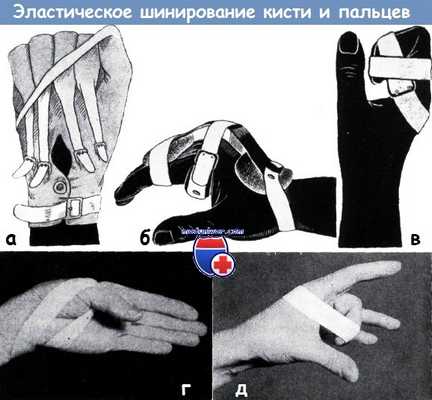 Эластическое шинирование пальцев кисти