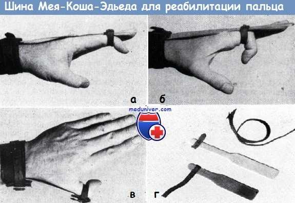 Шина Мея—Коша—Эдьеда для восстановления движения пальцев кисти