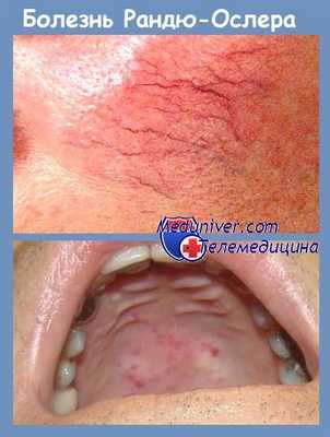 болезнь Рандю-Ослера