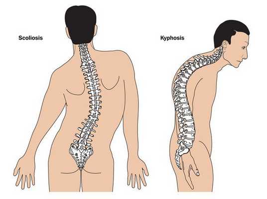Сколиоз и кифоз