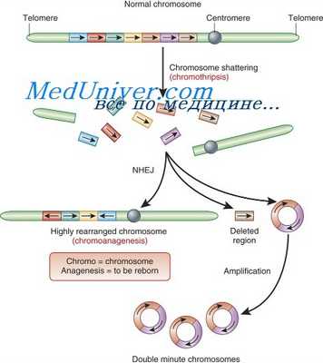 синдром марфана