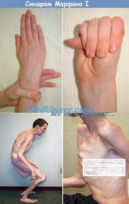 синдром Марфана I