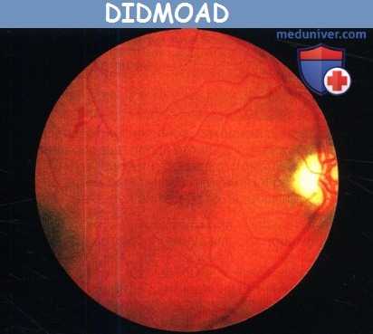 DIDMOAD