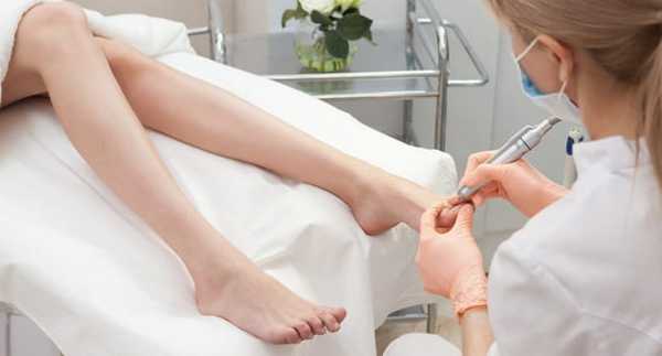 Онихолизис