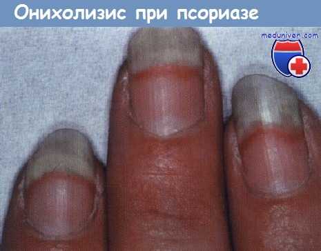 Онихолизис при псориазе