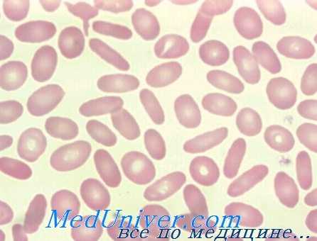 мазок при наследственном овалоцитозе
