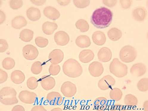 мазок крови при наследственном сфероцитозе