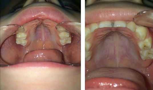 Симптом «готического неба»