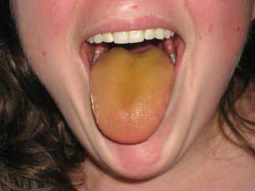 Желтый налет на языке