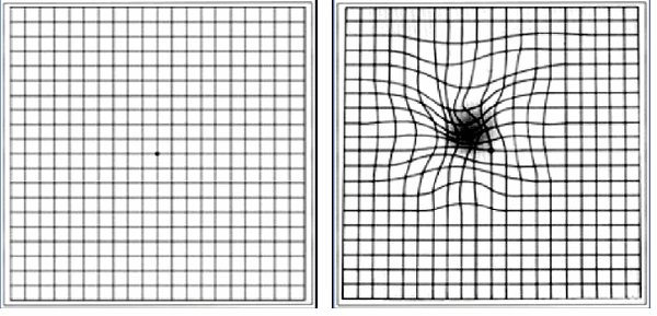 Тест Амслера