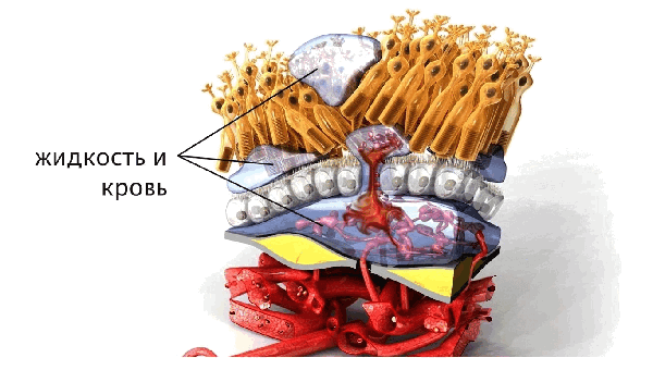 Макулодистрофия