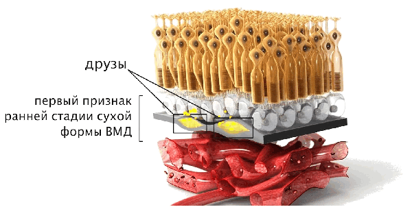 Макулодистрофия.