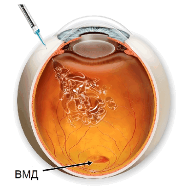 Лечение вмд