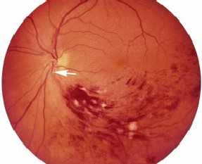 Ангиопатия сетчатки