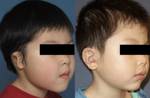 Результаты коррекции аномалии ушной раковины