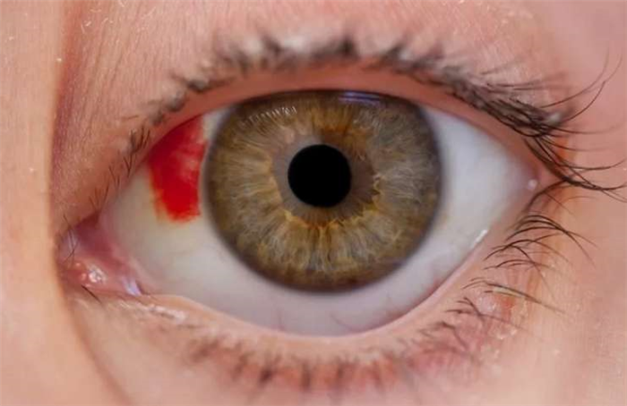 Механическое повреждение эпителия роговицы