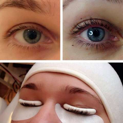 Процедура применения ботокса