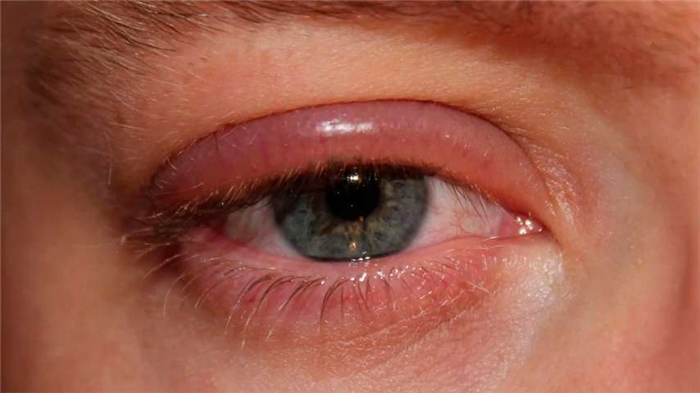 Отек и покраснение век