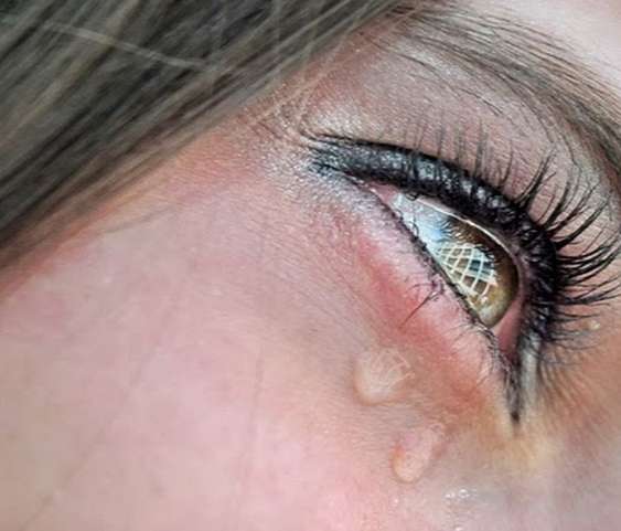 Слезящиеся глаза после ожога