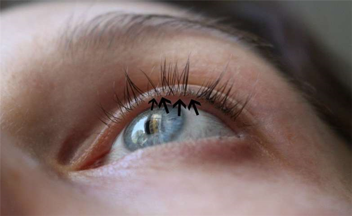 Очаговое выпадение ресничек