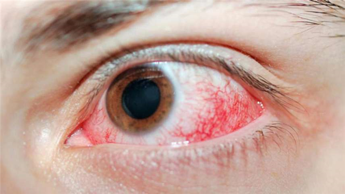 Химическое повреждение слизистой глаза