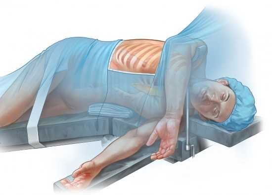 Торакоскоп вводят через прокол, сделанный в стенке грудной клетки