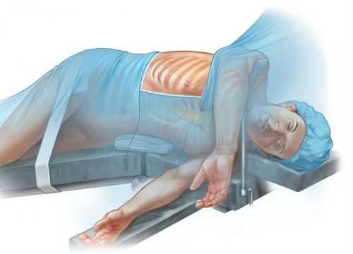 Положение при торакоскопии