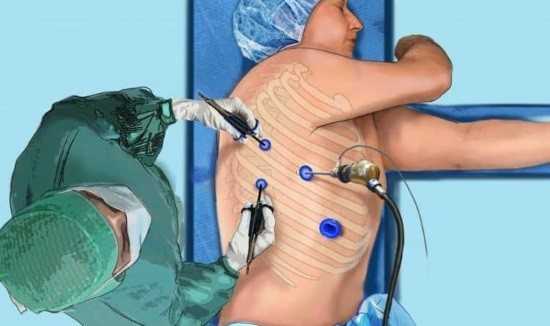 Проведение торакоскопии