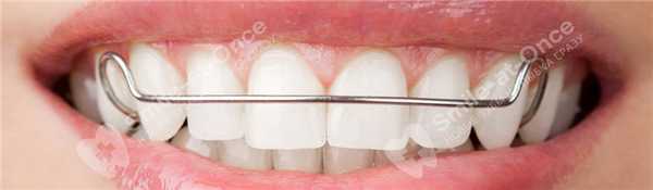Пластинки на зубы