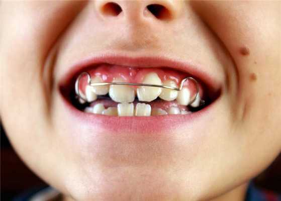Пластинки для исправления прикуса