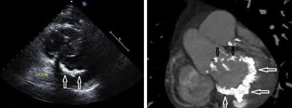 Кальциноз митрального клапана