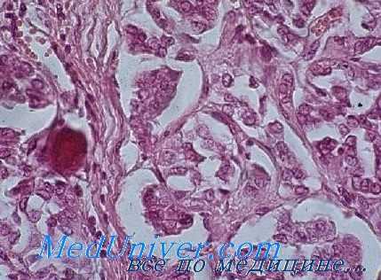 аденома околощитовидных желез