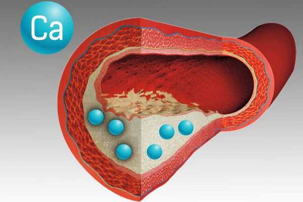 Отложения кальция в сосудах