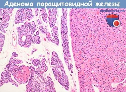 аденома околощитовидных желез